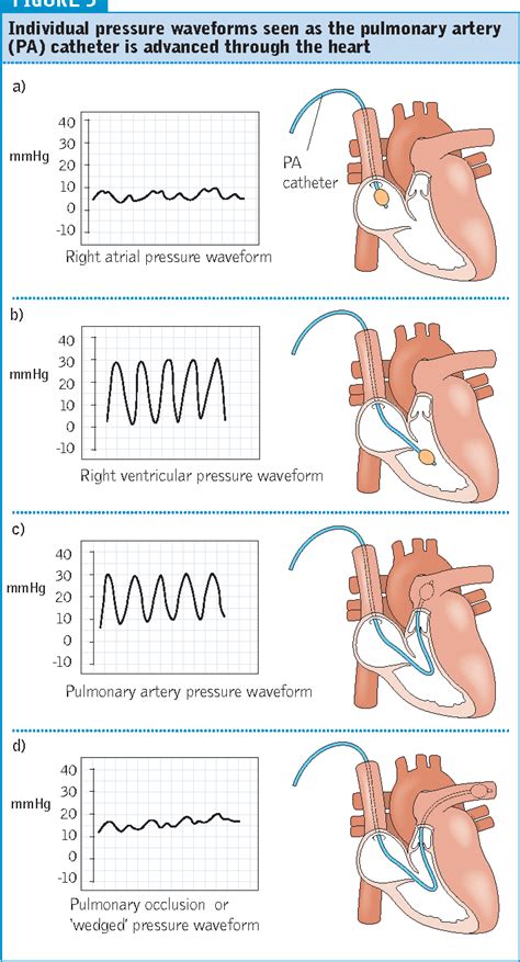 Pulmonary Artery Catheter Waveforms