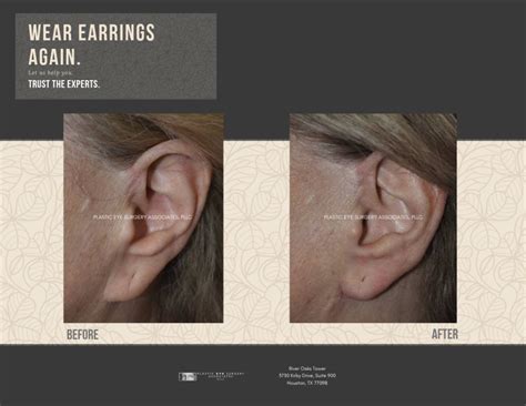 Earlobe Surgery Photos - Plastic Eye Surgery Associates