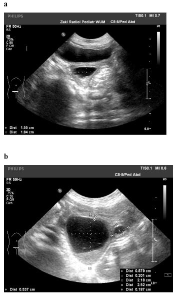 Congenital posterior urethral diverticulum in an infant with Robinow ...