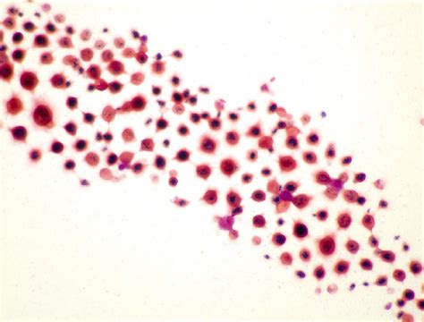 Cryptococcus Neoformans Gram Stain