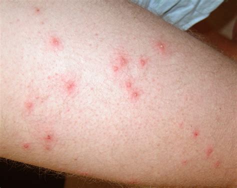 👉 Pseudomonas Folliculitis - Symptoms, Treatment, Pictures, Causes ...