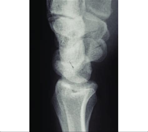 A scapholunate angle of greater than 60° on a lateral radiograph is ...