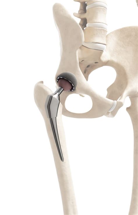 hip-joint-replacement