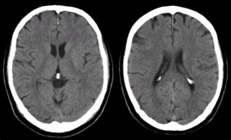 View Normal Brain Ct Scan Images US