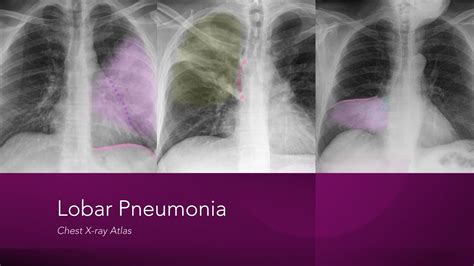 Left Lobar Pneumonia X Ray