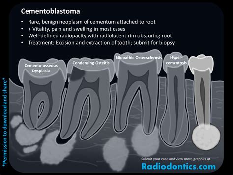 Osteitis Condensante