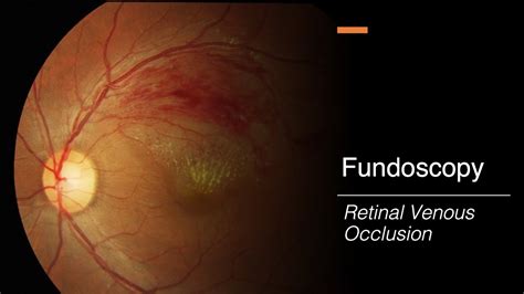 Retinal Venous Occlusion: Fundoscopy - YouTube