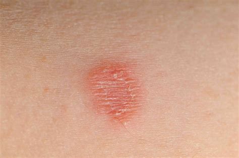 Ringworm: Causes, Signs Based on Skin Color, and Treatment