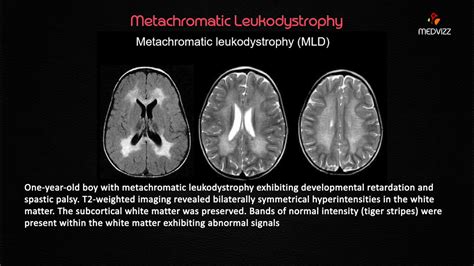 Metachromatic Leukodystrophy - USMLE Biochemistry webinar Case based ...