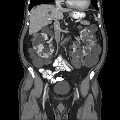 CT Scan of the Abdomen and Pelvis: With and Without Contrast ...