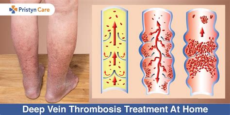 Deep Vein Thrombosis Treatment At Home - Pristyn Care