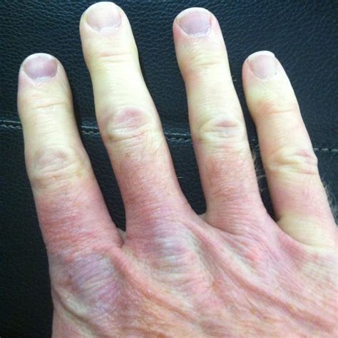 Raynaud Phenomenon - MSK - Medbullets Step 1