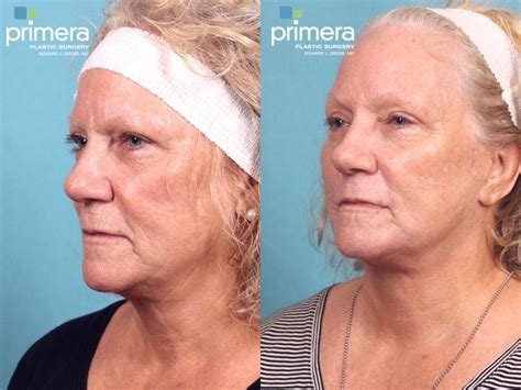 Chemical Peel Before and After Pictures Case 521 | Orlando, Florida ...