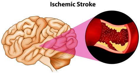 Treatment for Stroke-Could PEMF Therapy be an Accepted Therapy in ...