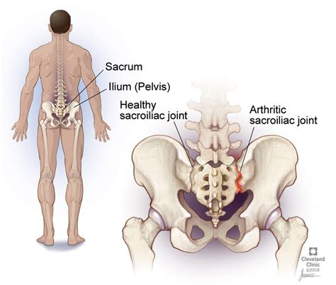 What is a Sacroiliac Joint Injection? - Integrative Pain & Spine Institute