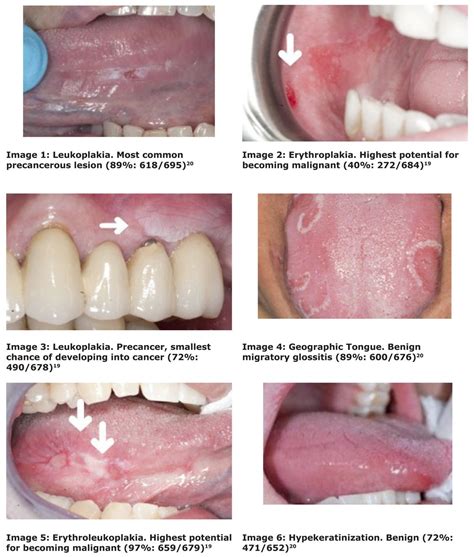 Detection of Early-Stage Oral Cancer Lesions: A Survey of California ...