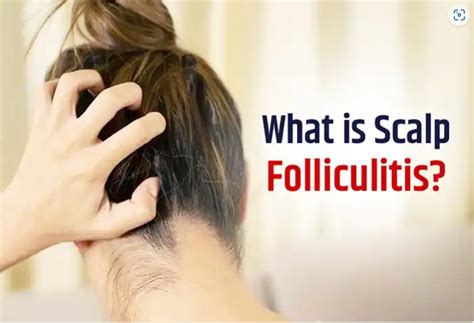 Scalp Folliculitis: Causes, Symptoms, Treatment, and Prevention - Vizz Blog