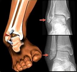 Ankle Fracture Repair Treatment & Surgery | Spine & Orthopedic Center