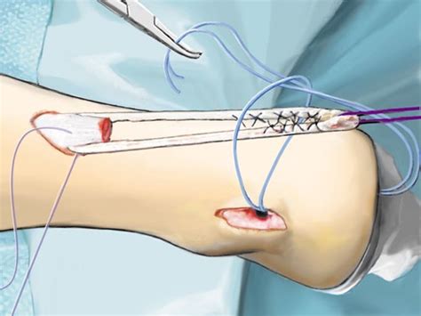 8 The semitendinosus tendon graft is passed through a medial-to-lateral ...