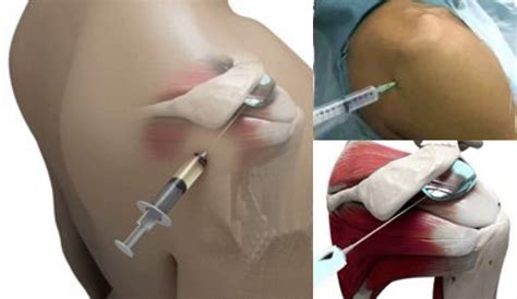 Fig 7A. Subacromial Injection - Cambridge Shoulder