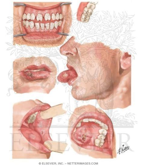 Syphilis Chancre Tongue