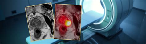 Latest Prostate Cancer Imaging Technique Transforms Our Ability to ...