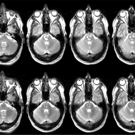 Diffusion-weighted imaging of the pontine infarct at baseline. (A ...