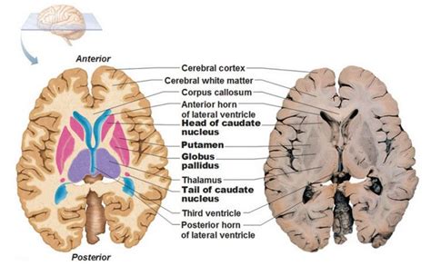 Basal ganglia, Basal ganglia anatomy, Basal ganglia stroke