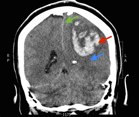 Brain Bleed CT Coronal Annotated. JETem 2017 - JETem