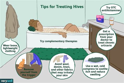 Hives (Urticaria) Treatment