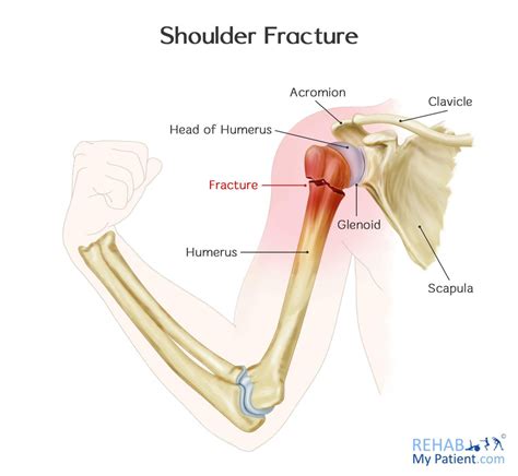 Shoulder Fracture | Rehab My Patient