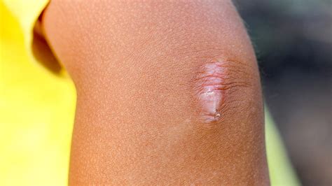 Scar tissue pain: What it feels like, why it happens, and treatment