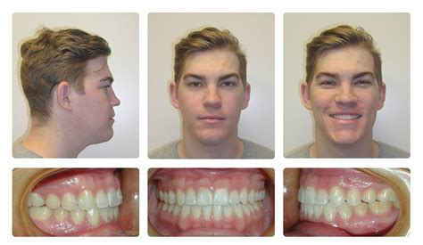 Orthodontic Before and After Photos | Brodsky Orthodontics