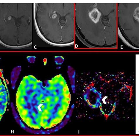 Right frontal brain metastasis in a patient affected by lung cancer ...