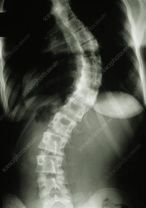 X-ray showing scoliosis (curvature) of the spine - Stock Image - M350 ...