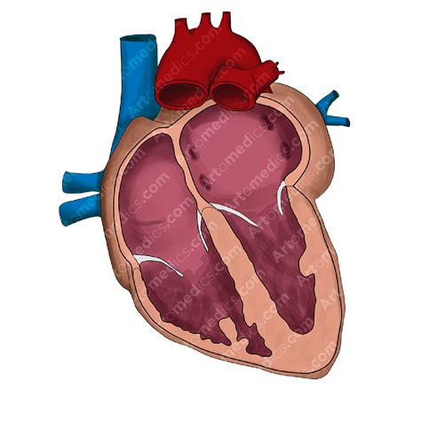 Left Atrial Enlargement (Anterior View) - Artomedics Studio