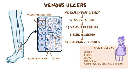 Pathophysiology Of Venous Ulcers