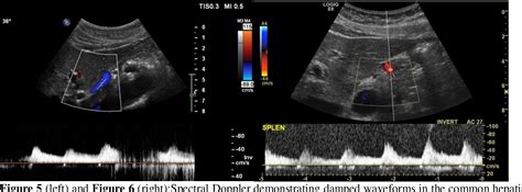 Figure 5 from Median Arcuate Ligament Syndrome Confirmed With Vascular ...