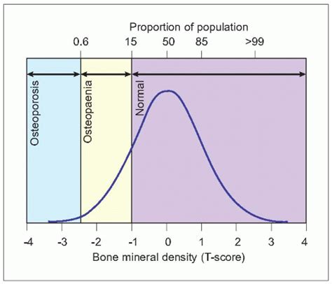 Bone Density Screening Chart