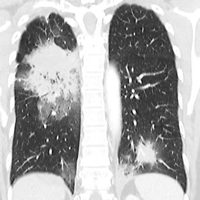 Pulmonary Metastases | Radiology Key