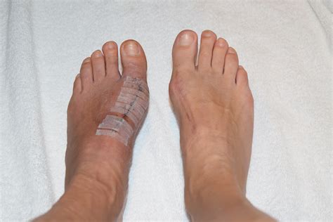 Lapidus Bunion Surgery – My journey with back-to-back foot surgeries ...