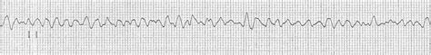 Ventricular Fibrillation (VF) • LITFL • ECG Library Diagnosis