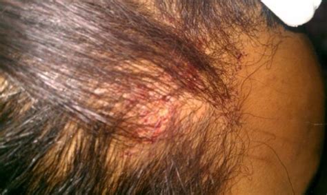 Scabs on Scalp: Causes, Treatment & Remedies | Treat, Cure Fast