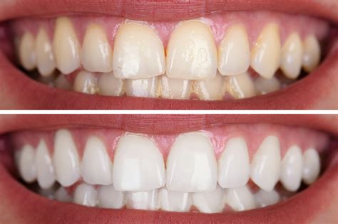 Teeth Whitening | Cosmetic Dentistry | Dental Hygiene