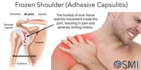 3 Stages of Frozen Shoulder: Orthopaedic Specialists: Orthopedics