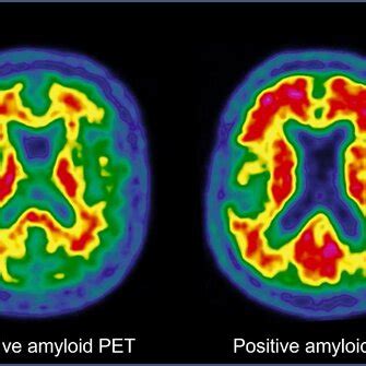 Typical images of amyloid PET imaging. On the left part, a typical ...