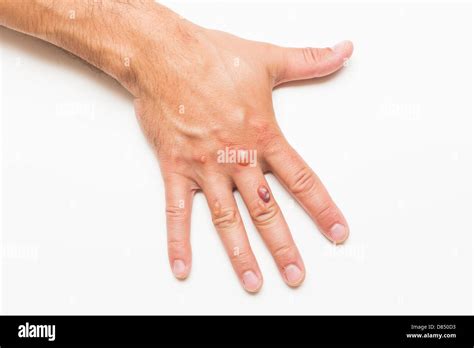 Man's hand covered with blisters caused by cryosurgery - wart removal ...