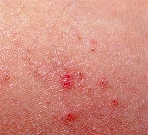 The Best Scabies Treatment | Healthy Living