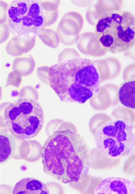 Who Classification Of Acute Leukemia