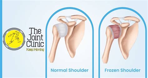 Causes of frozen shoulder | General center | SteadyHealth.com